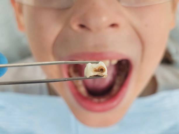 Best Emergency Root Canal Treatment in Shell Ridge, CA